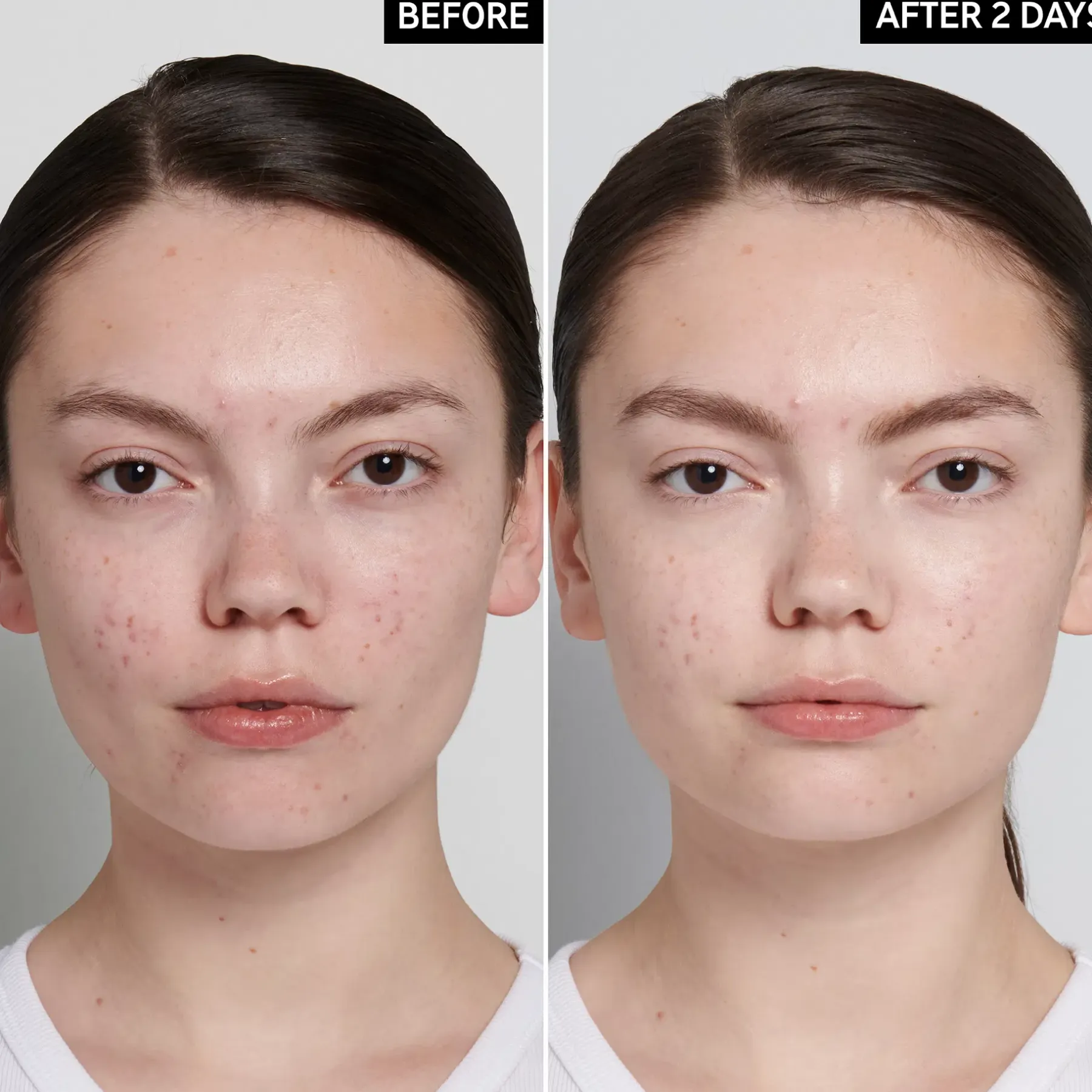 Hot Succinic Acid Treatment hoitovoide 15 ml Kasvojenhoito